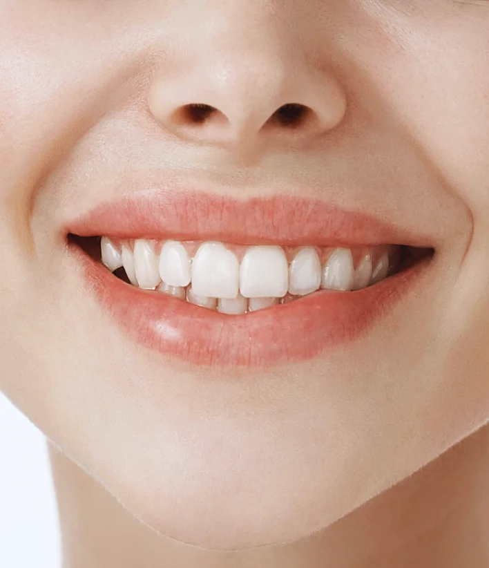 after Teeth Whitening after Teeth Whitening