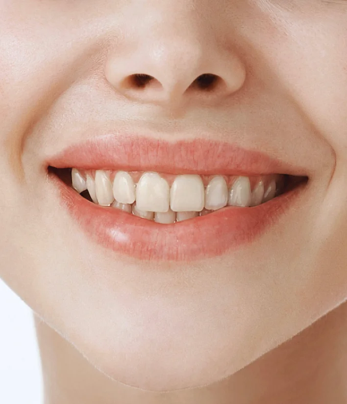 before Teeth Whitening before Teeth Whitening