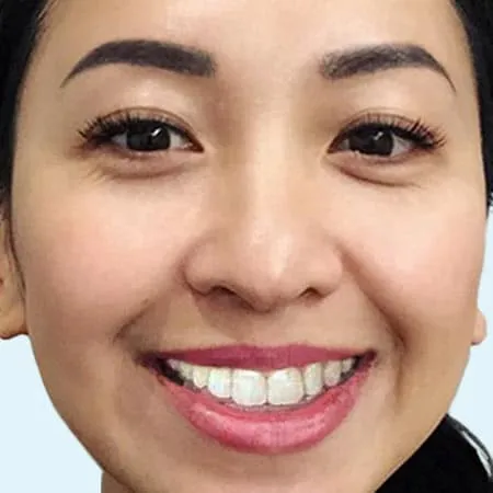 ugc slider after 0002 1 alignerinvisalign ugc slider after 0002 1 alignerinvisalign