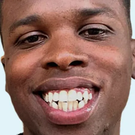 ugc slider before 0003 alignerinvisalign ugc slider before 0003 alignerinvisalign